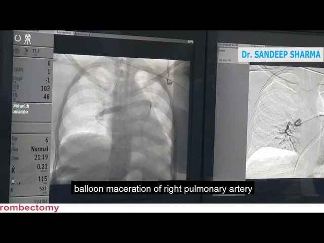 COVID and Pulmonary Thrombosis